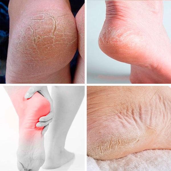 Palmilha de Silicone Anti Rachadura - Foot Care