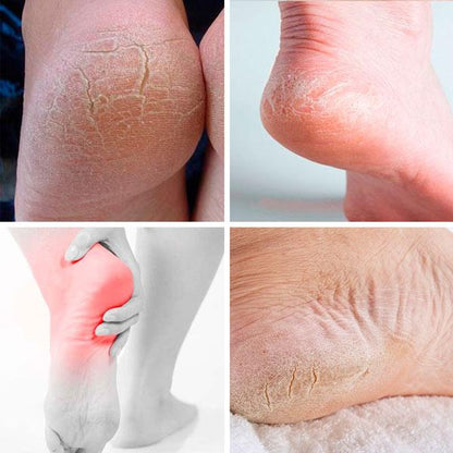 Palmilha de Silicone Anti Rachadura - Foot Care